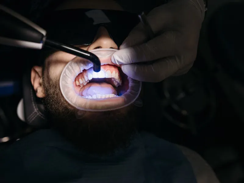 Dentist using UV bleaching lamp on patient during in-office teeth whitening treatment at Deekshu Dental Bangalore