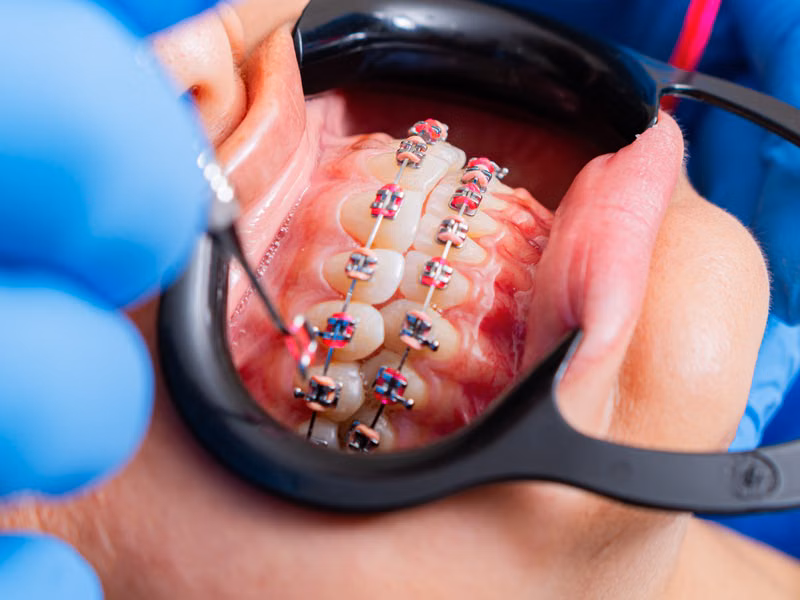 Benefits of Ceramic Braces for Kids — Ceramic Braces Sarjapura
