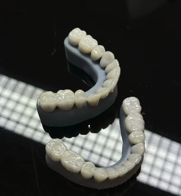 Porcelain dental veneers and crowns close-up — metal-free biocompatible restorations Bangalore