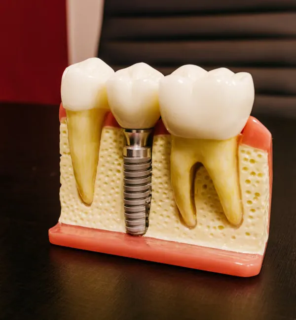 Ceramic zirconia dental crown model showing high-strength biocompatible tooth restoration Bangalore