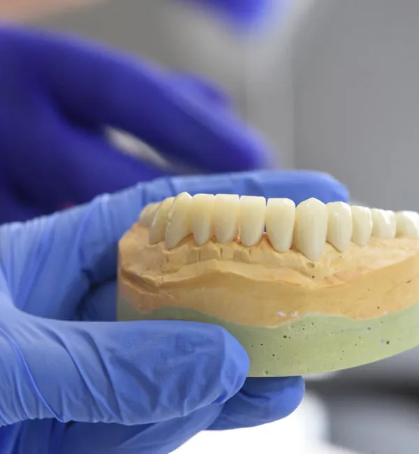 Dental lab technician holding PFM crown model — porcelain fused to metal restoration Bangalore