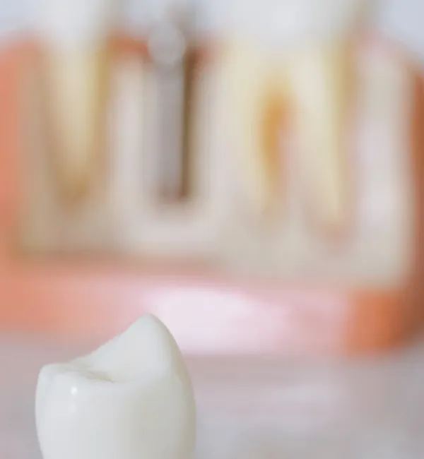 All-ceramic metal-free dental crown prosthetic close-up — precision fit Sarjapura Bangalore