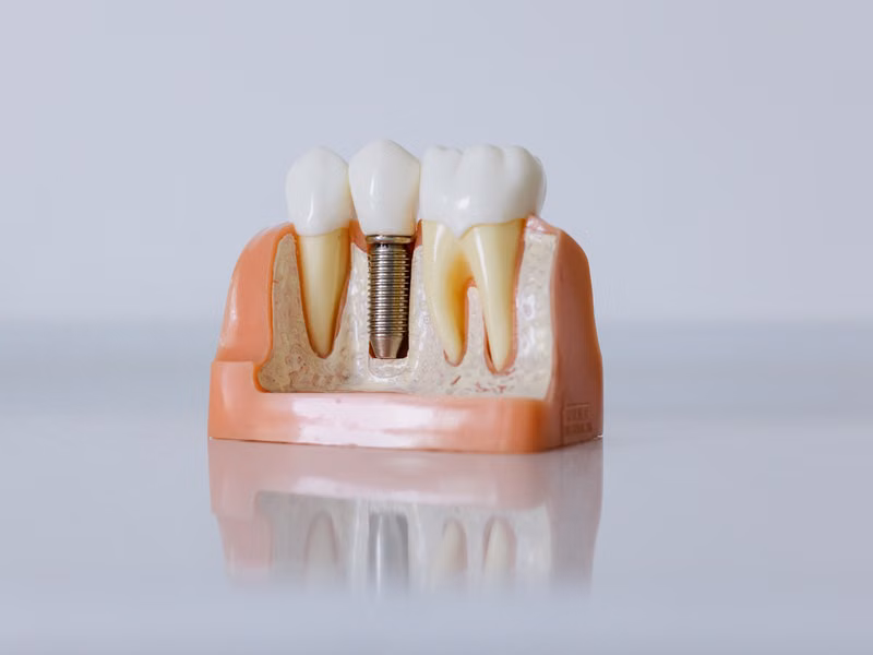 What to Expect from Start to Finish — Dental Implants Process Sarjapura