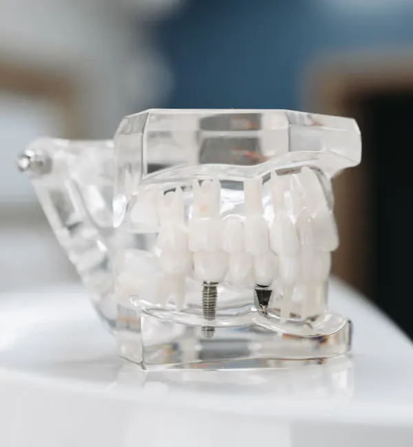 Ceramic dental implant model in artificial mouth — implant-supported denture anchor Sarjapura Bangalore