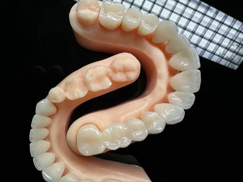 Detailed dental mold model showing full teeth arrangement used for full mouth rehabilitation planning in Sarjapura, Bangalore
