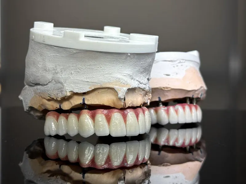 Premium realistic dental prosthetic models showcasing full mouth crown and bridge restorations used in Sarjapura, Bangalore