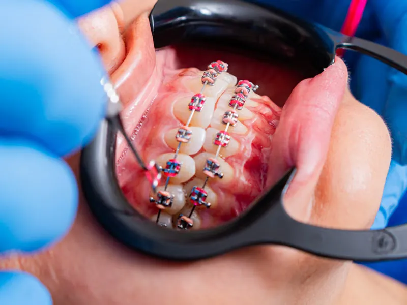 Orthodontist placing metal braces brackets on patient teeth at Deekshu Dental Sarjapura Bangalore
