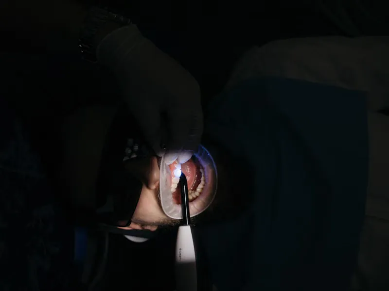 Orthodontist precisely positioning lingual brace bracket with dental tweezers for hidden orthodontic treatment at Sarjapura
