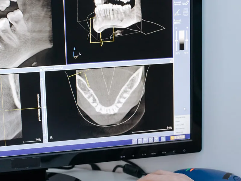 Endodontist performing root canal treatment using digital X-ray diagnosis at Deekshu Dental Implant Center, Sarjapura, Bangalore