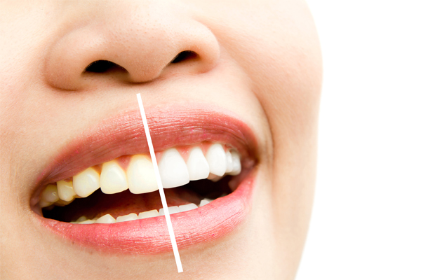 deekshu-dental-bleaching-1