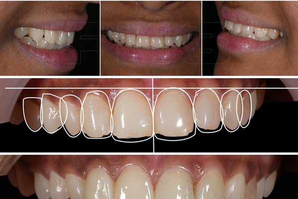 deekshu-dental-cosmeticdentistry2
