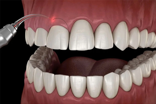 deekshu-dental-cosmeticdentistry5