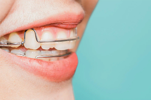 deekshu-dental-cosmeticdentistry7