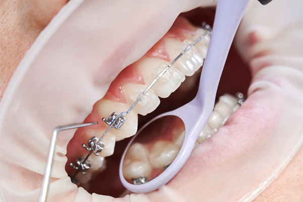 deekshu -orthodontics-7