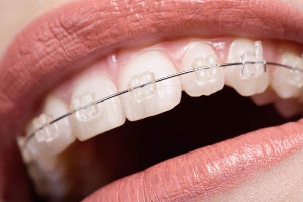 deekshu - orthodontics- ceramic