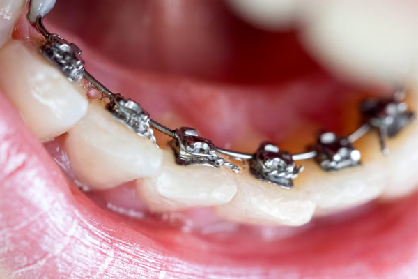deekshu-orthodontics-lingualbraces