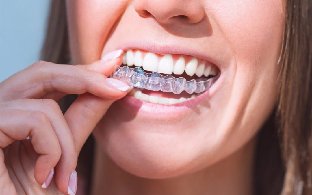 Invisalign Treatment