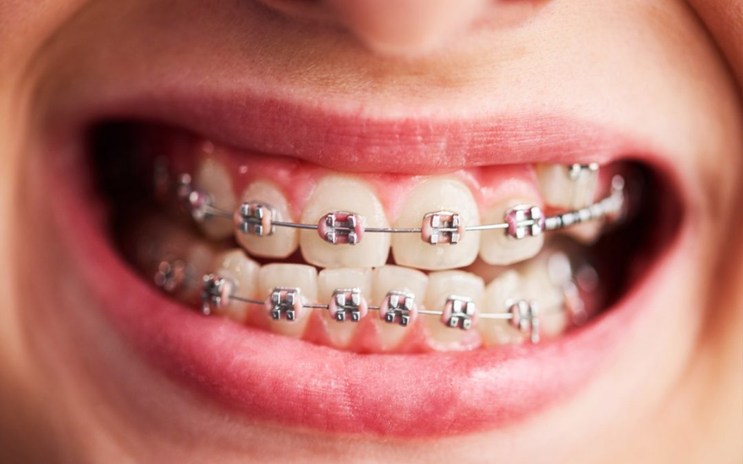 Benefits of Ceramic Braces for Kids: A Comprehensive Guide